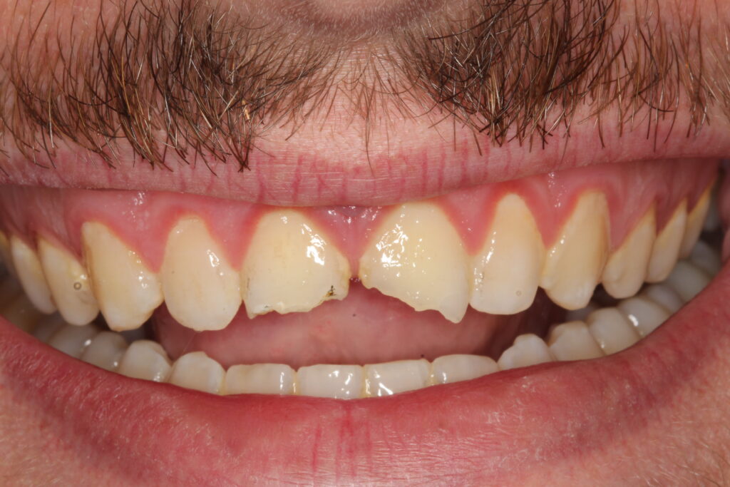 Before picture of teeth