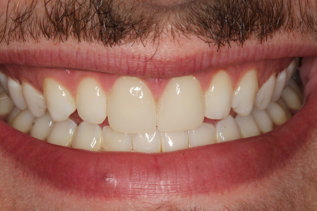 After picture of teeth