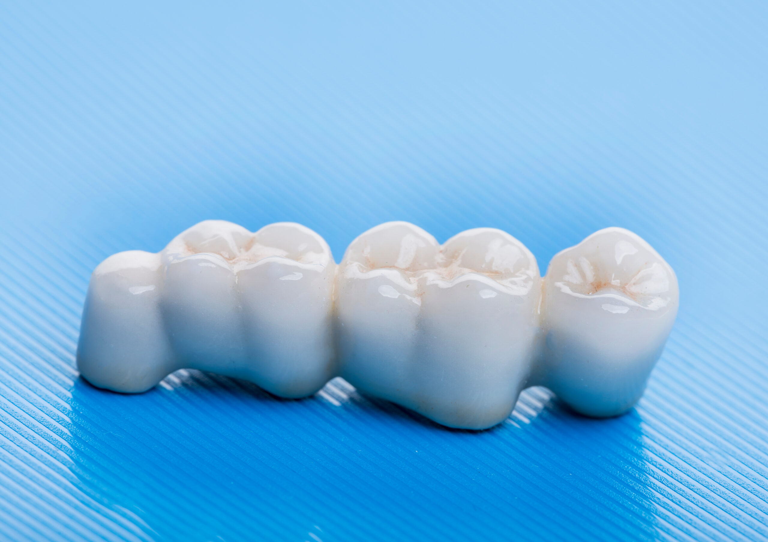 Dental Bridges and Partials