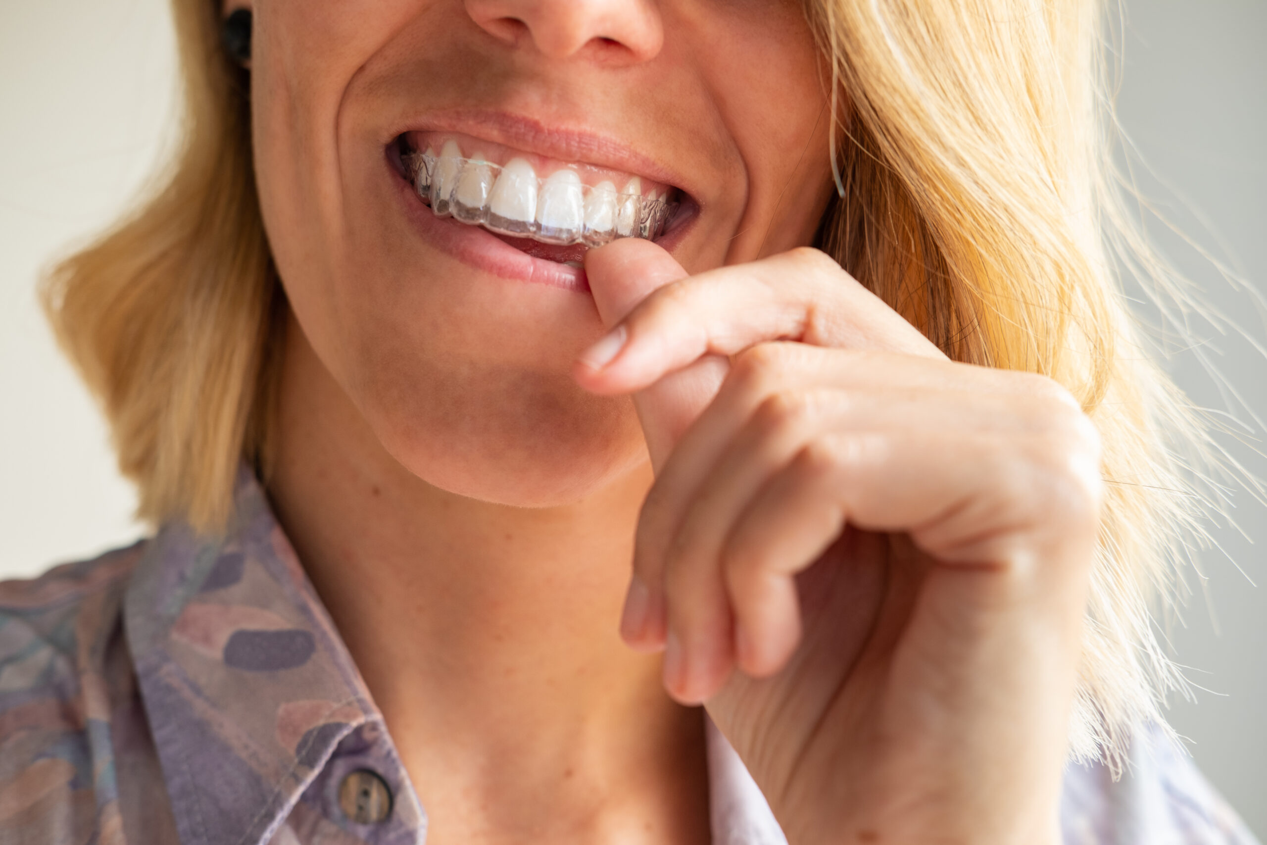 Beautiful smile and white teeth of a young blonde woman with invisible braces