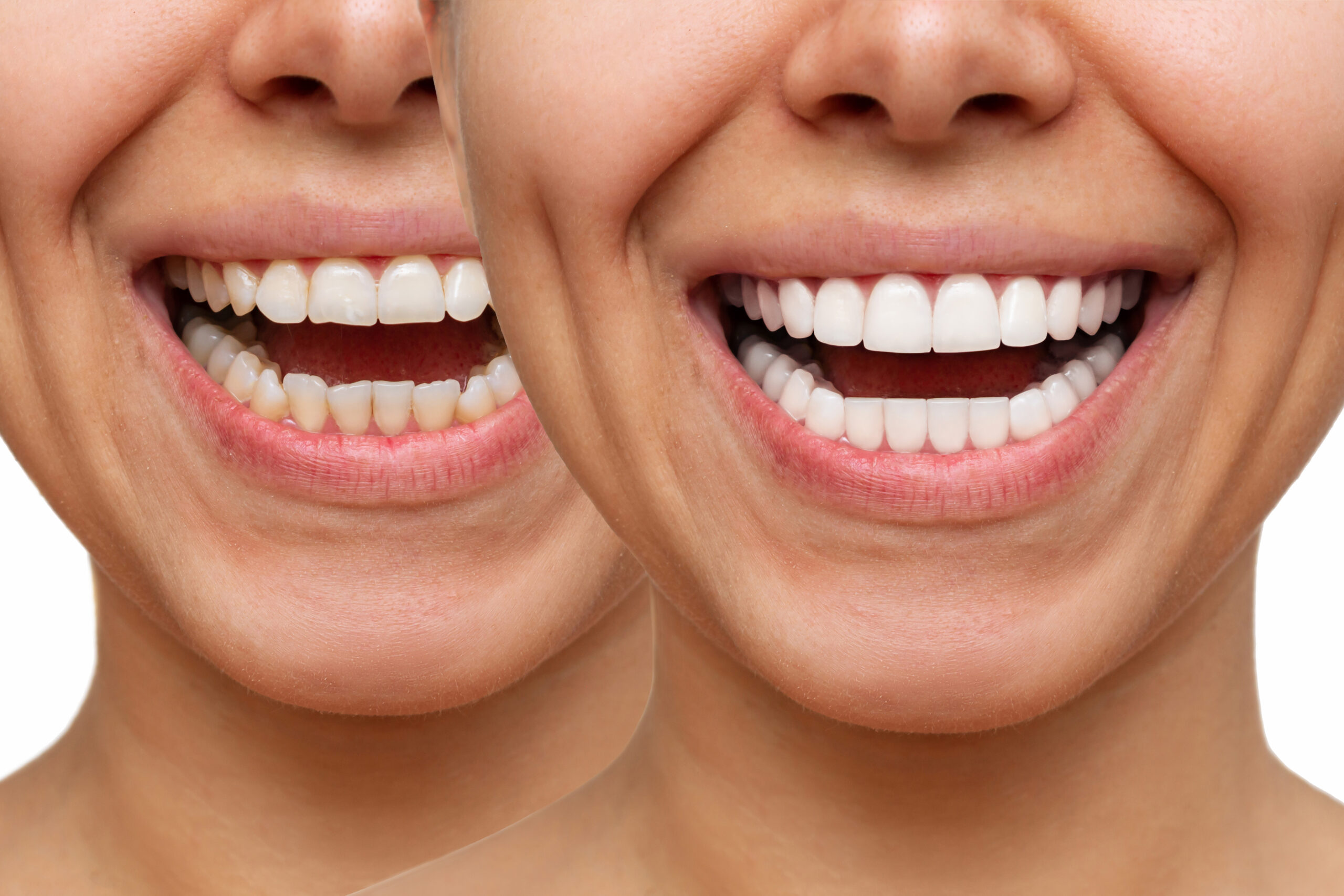 Cropped shot of a young caucasian smiling woman before and after veneers installation on a white background. Teeth whitening. Dentistry, dental treatment